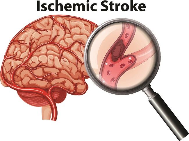 Gejala Awal Stroke